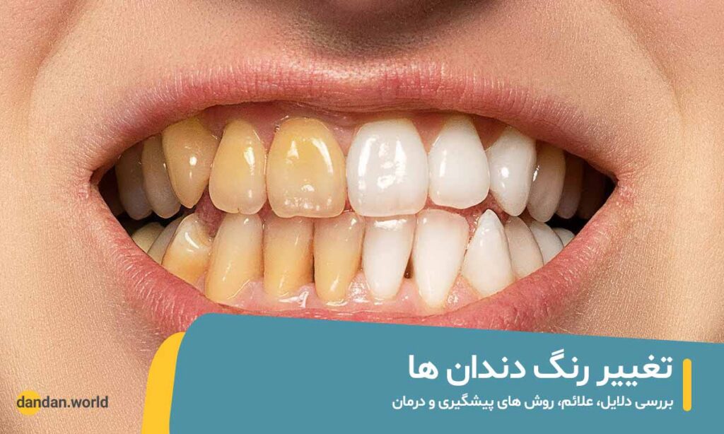 تغییر رنگ دندان