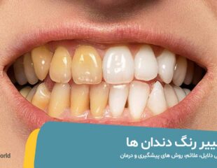 تغییر رنگ دندان