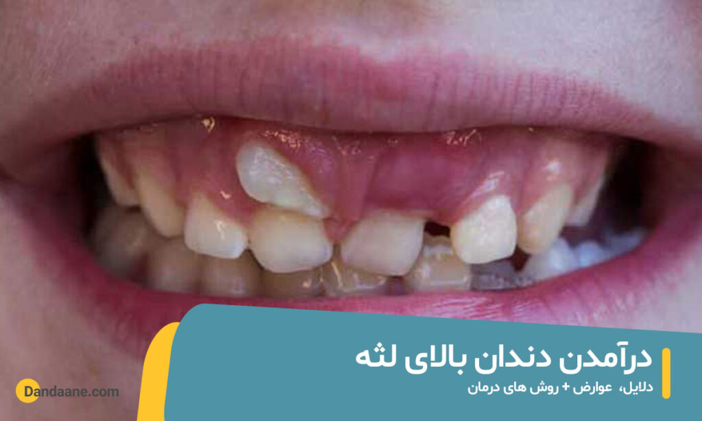 درآمدن دندان بالای لثه