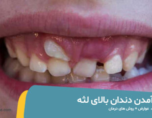 درآمدن دندان بالای لثه