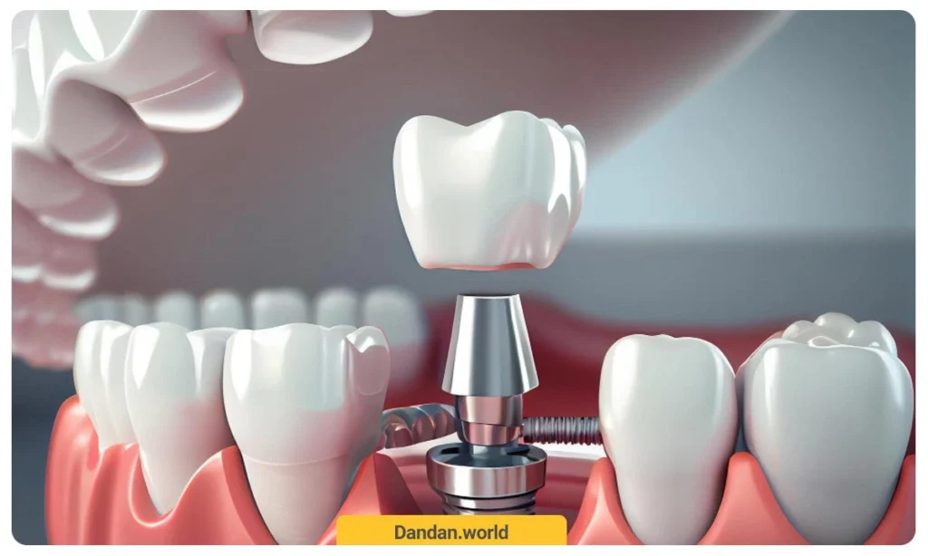 ایمپلنت دندان