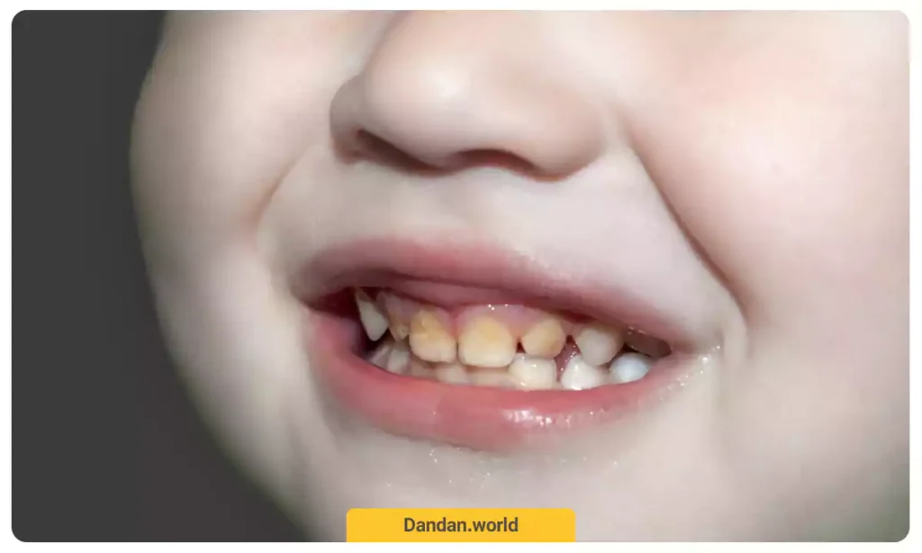 عکس فرسایش مینای دندان در کودکان