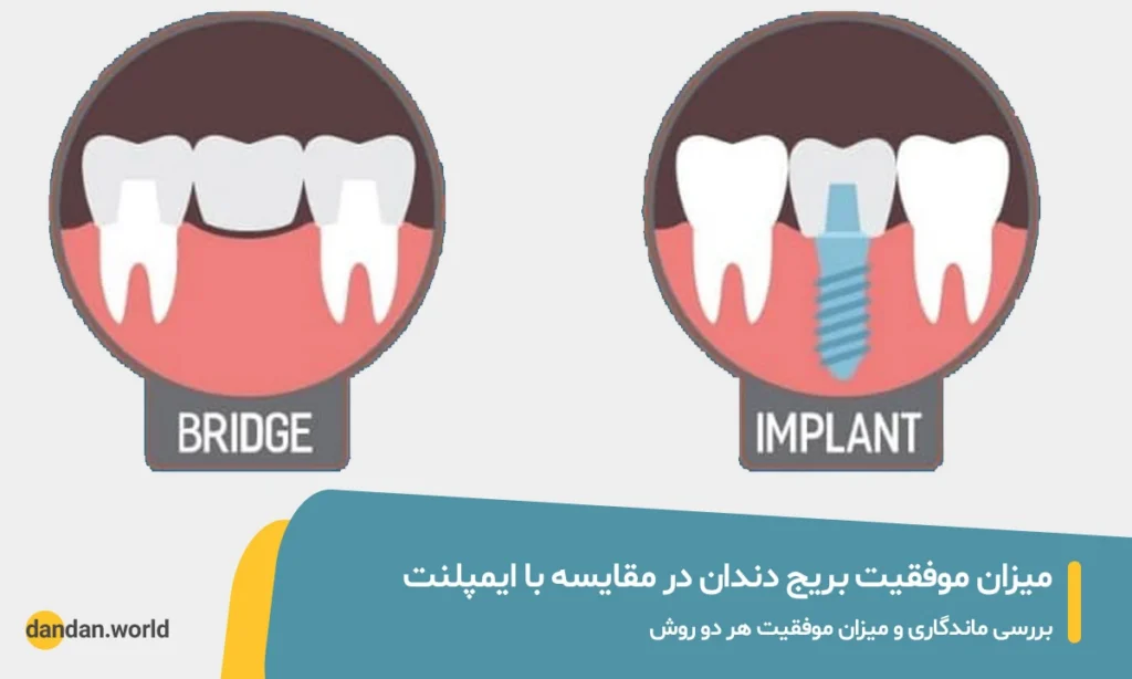 میزان موفقیت بریج دندان در مقایسه با ایمپلنت