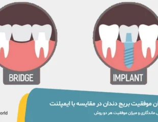 میزان موفقیت بریج دندان در مقایسه با ایمپلنت