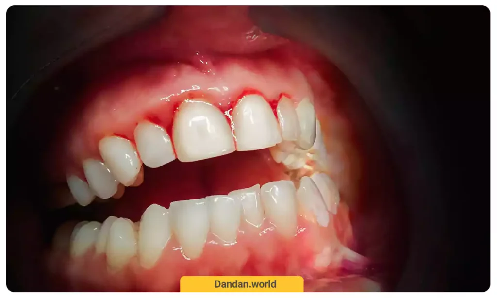 خونریزی لثوی بعد از جراحی لثه