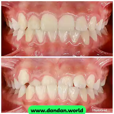 قبل و بعد نمونه کار درمان ارتودنسی دکتر فاطمه تیموری