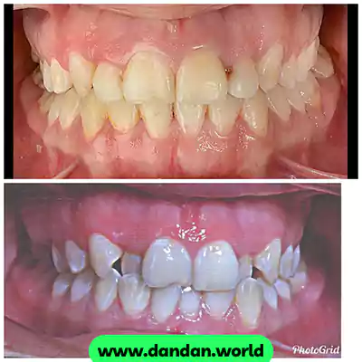 نمونه درمان ارتودنسی دکتر فاطمه حیدری