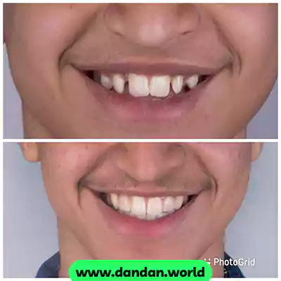 نمونه درمان ارتودنسی و اصلاح طرح لبخند دکتر فاطمه تیموری